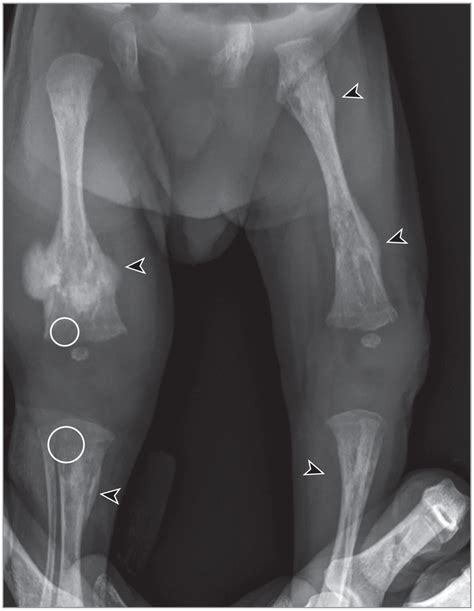 Osteopenia And Multiple Fractures In An Infant With Harlequin Ichthyosis Jama Dermatology