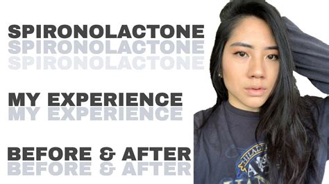 Spironolactone Changed My Skin My Experience Before And After 9