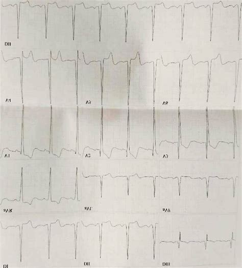 Electrocardiograma Con Hipertrofia Ventricular Izquierda Download