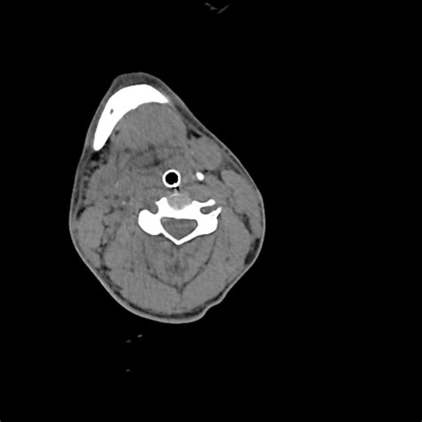 Atlanto Occipital Dissociation Traynelis Type 1 C2 Teardrop Fracture