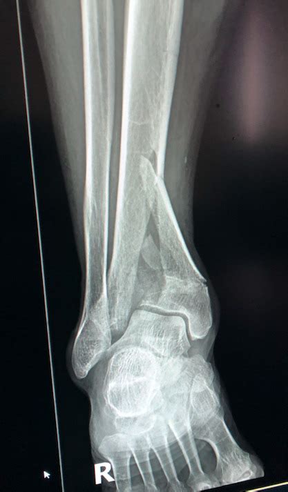Figure Distal Tibia Pilon Fracture Contributed By Andrew Hadeed Do