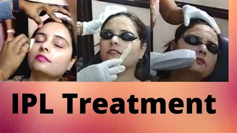 Ipl Photofacial Review After First Treatment ~ Before And After Youtube
