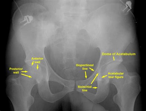 Pin En Fracturas Y Clasificaciones En Pelvis