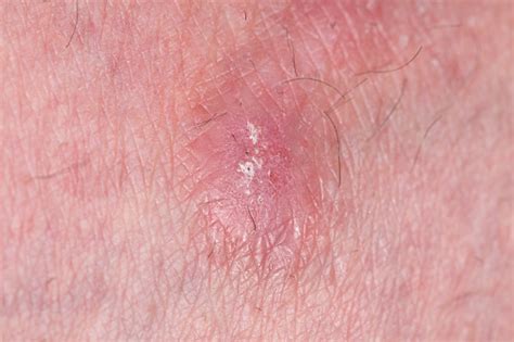Atopic Dermatitis Dermatitis Skin Disease Stock Photo Download Image