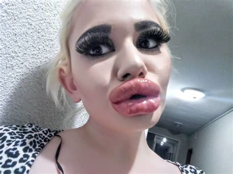 A Bulgarian Girl Had Lip Augmentation Surgeries And Wants More