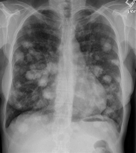 Chest X Ray Revealing Multiple Lung Nodules A Computed Tomography The