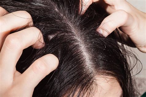 21 Reasons For Your Itchy Scalp Besides Head Lice Readers Digest