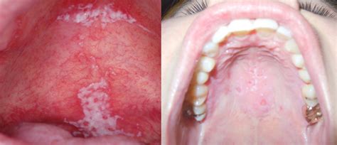 bump on roof of mouth definition symptoms causes treatment and more