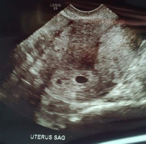 Ultrasound Pictures Of Twins At 5 Weeks - the meta pictures