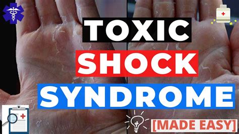 Toxic Shock Syndrome Pathology Clinical Presentation Diagnosis
