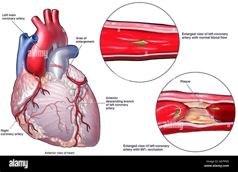 Enfermedad De La Arteria Coronaria Principal Al Fatal Ataque Al Corazón