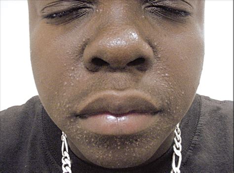 Papular Facial Eruption In An African American Adolescent—quiz Case