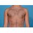 Chest Contouring With Pectoral Augmentation In Dallas Texas  Dr