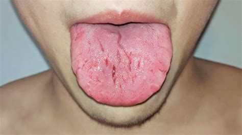What Your Tongue Reveals About Your Health