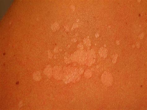 Tinea Versicolor Symptoms Causes Diagnosis And Treatment