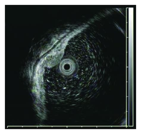 Evaluation Of Endoscopic Ultrasound Image Quality Is Necessary In