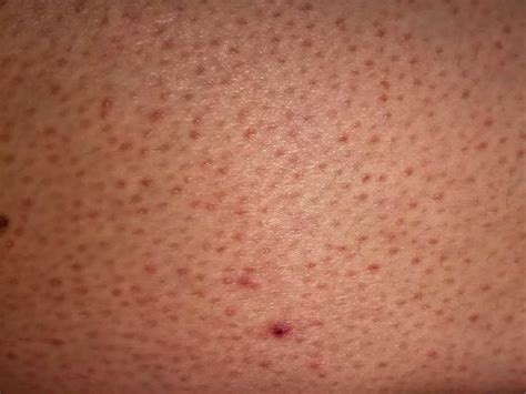 Body Acne Keratosis Pilaris How To Tell The Difference