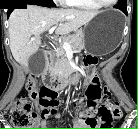 Distal Common Bile Duct Dilatation Due To Cbd Tumor Liver Case