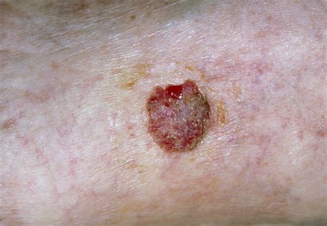 Squamous Cell Cancer Of Skin On Leg Stock Image M Science Photo Library