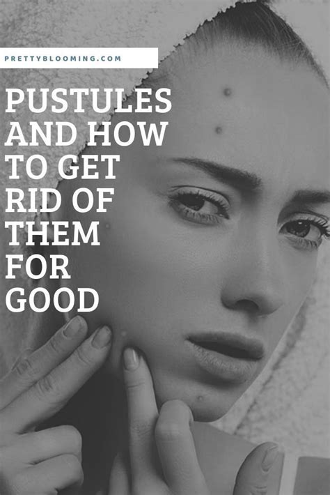 Have You Suffered Long Enough From Pustules If You Experience Acne In