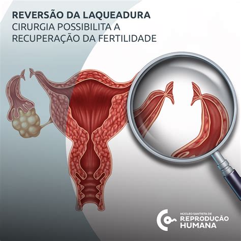 Reversão da laqueadura cirurgia possibilita a recuperação da