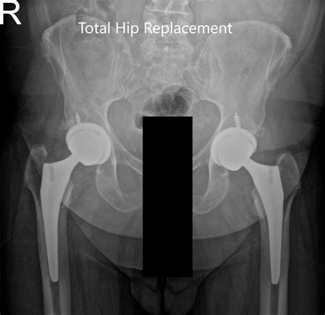 Case Study Bilateral Hip Replacement In 65 Year Old