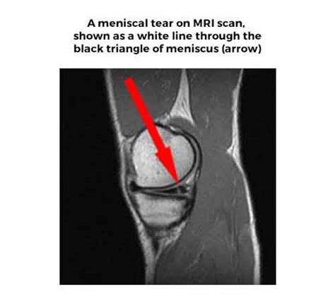 Meniscal Cartilage Tears And Injuries Symptoms Diagnosis And Treatments