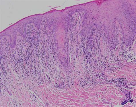 Oral Lupus Erythematosus European Association Of Oral Medicine