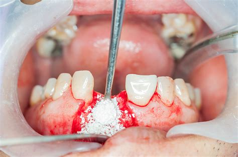 【トリー】 Bone Augmentation In Implant Dentistry ボーンオグ