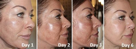 The Perfect Derma Peel Rejuvenated Skin In One Week Aestheticaskin