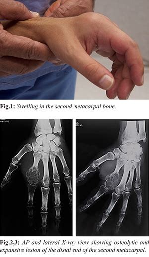 Reconstruction Of The Second Metacarpal Bone After Bone Tumor Resection