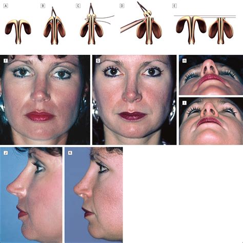 nasal tip overprojection jama facial plastic surgery the jama network