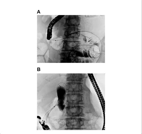 Figure E Double Stenting Procedure For Concurrent Biliary And Duodenal