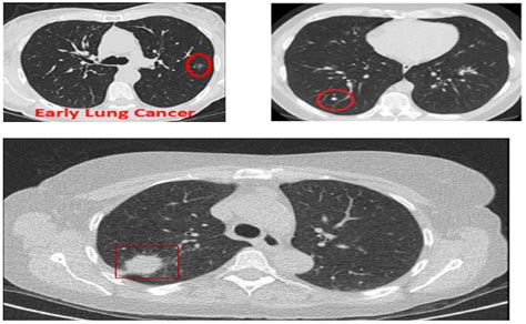 Cancers Free Full Text An Effective Method For Lung Cancer Diagnosis From Ct Scan Using Deep
