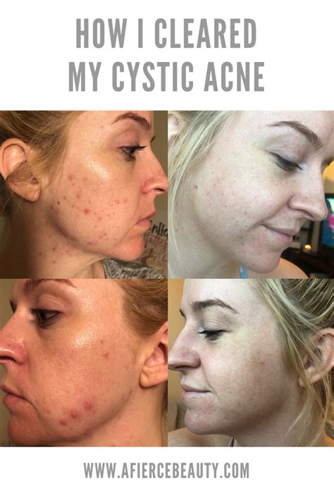 How I Finally Cleared My Cystic Hormonal Acne Cystic Acne Acne Hormonal Acne