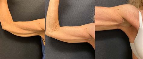 Before And After Mini Arm Lift Neinstein Plastic Surgery