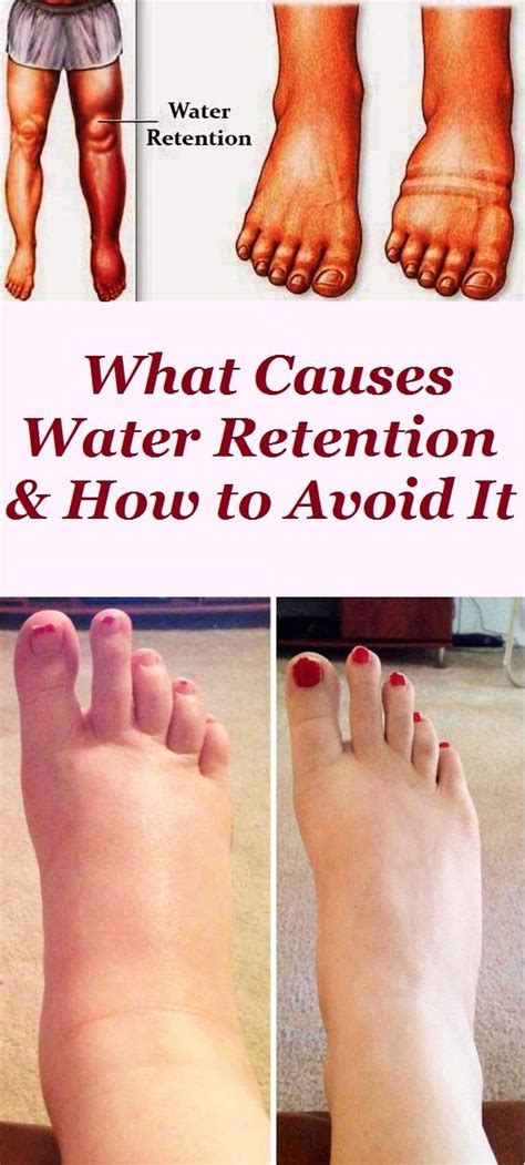 What Causes Water Retention And How To Avoid It With Images Water