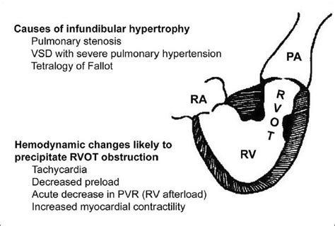 Pin On Right Ventricular Outflow Tract Obstruction