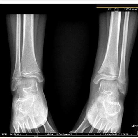 Ct Scan Showing Osteolytic Lesion Of The Metaphysis Of Left Tibia