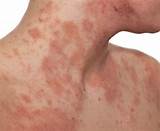 Images of Weeping Eczema Treatment