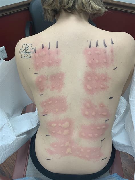 Got Some Testing Done Today Heres What My Back Looked Like When Done