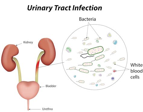 Urinary Tract Infection What Is Vivoo Uti Box Vivoo