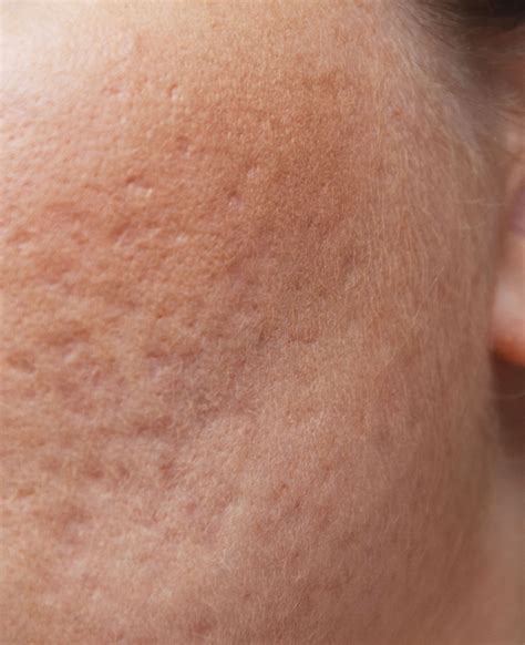 Laser Combination Or Full Ablative Resurfacing Scar Treatments Acne