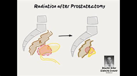 Doctor Explains Radiation For Rising Psa After Prostate Cancer Surgery Youtube