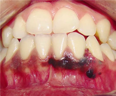37 Lesiones En Mucosa Oral Tips Mantica