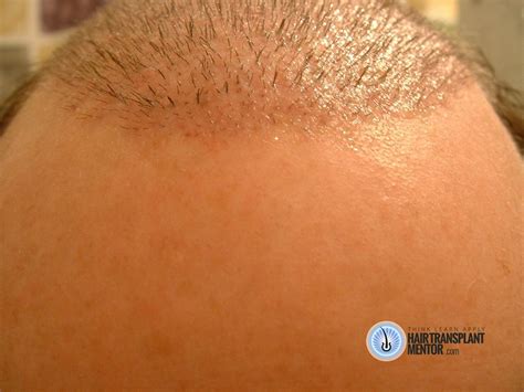 You can expect a hair transplant to take between four and eight hours. Hair Transplant Repair Photos!