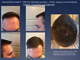 Photos of Hair Loss Treatment Chicago