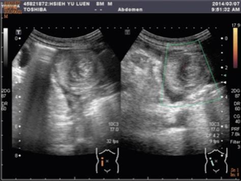 Abdominal Sonography Multiple Target Lesions Indicating