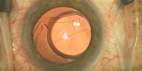 Surgical Management Of Decentered Iol American Academy Of Ophthalmology