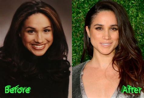 Meghan Before And After Rhinoplasty Operation Nose Celebrity
